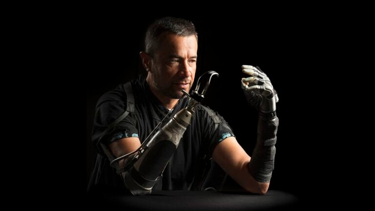 Amputees often feel disconnected from their bionic hands. AI could bridge the gap : Shots